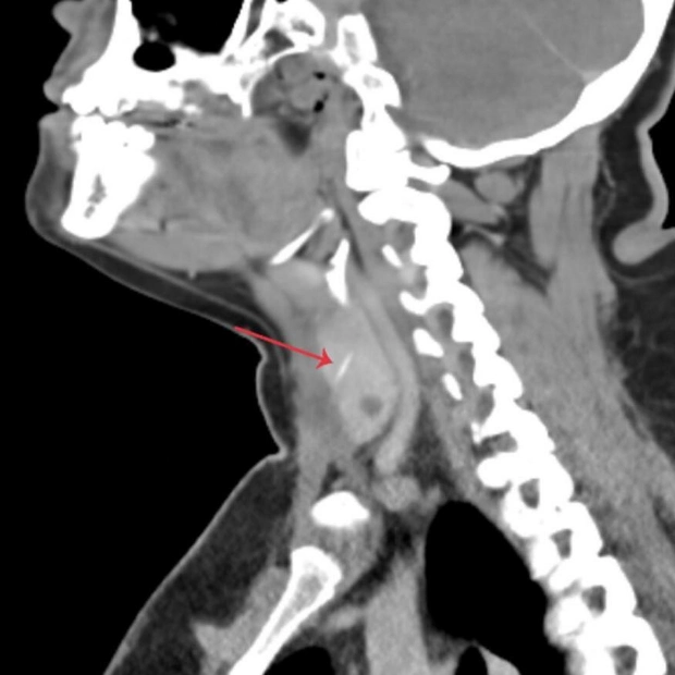 Fishbone Lodged in Thyroid Gland: A Rare Medical Case in Dubai