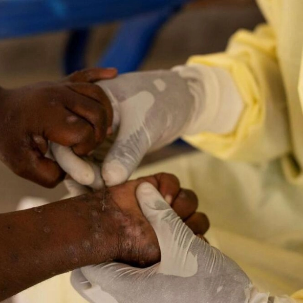 WHO Considers Declaring Mpox Outbreak in Africa a Global Emergency