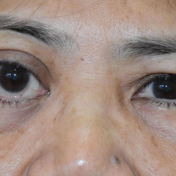 Massive Tumour Successfully Removed from Elderly Woman’s Eye