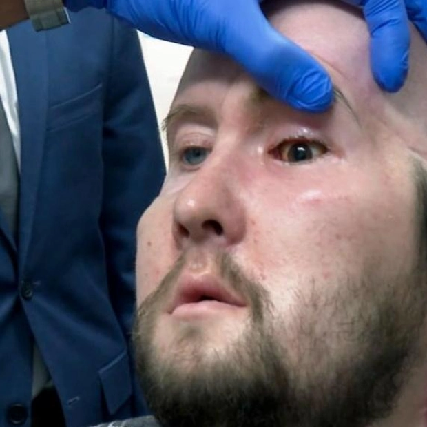 First Partial Face Transplant Including an Eye: One Year Update