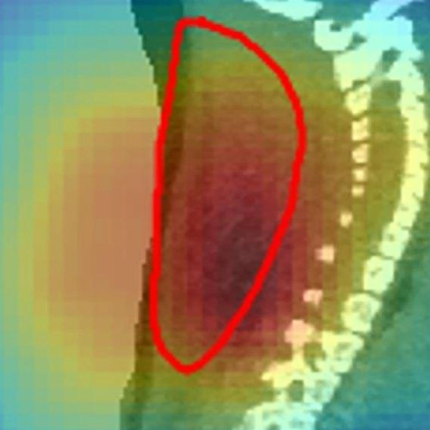 Radioactive Particle Beams Successfully Target Tumors in Mice