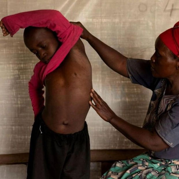 CDC Issues Second Alert on Deadly Mpox Virus in DRC