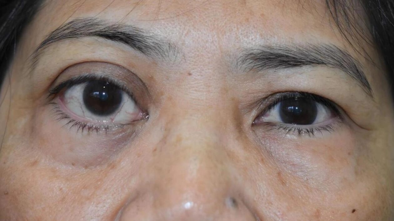 Massive Tumour Successfully Removed from Elderly Woman’s Eye