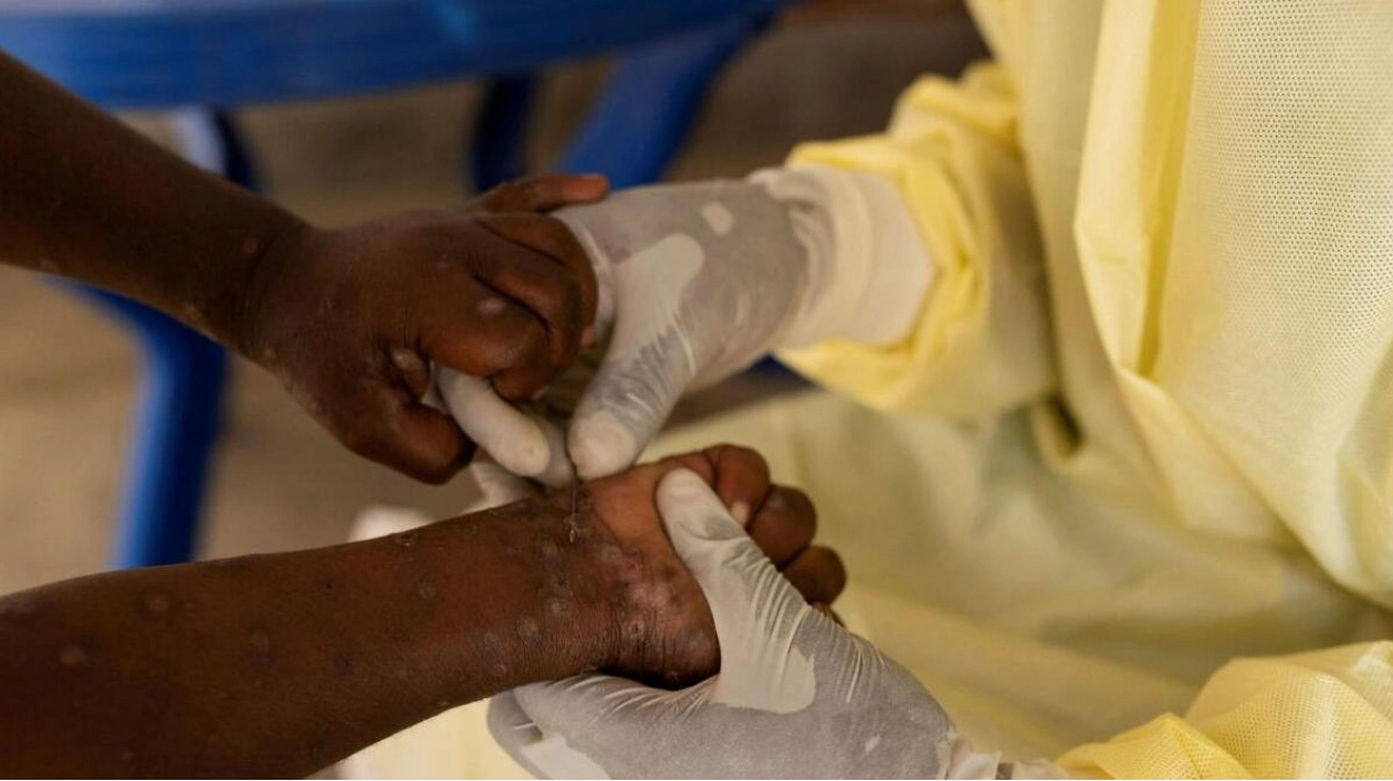 WHO Considers Declaring Mpox Outbreak in Africa a Global Emergency