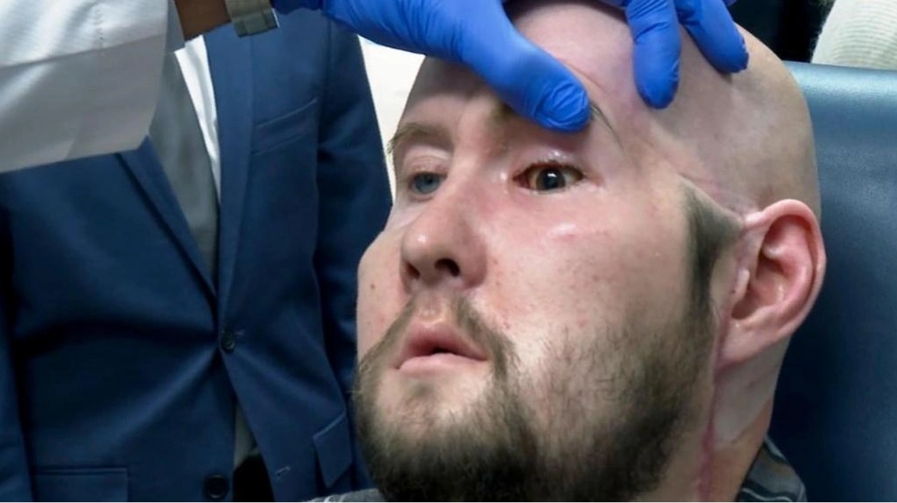 First Partial Face Transplant Including an Eye: One Year Update