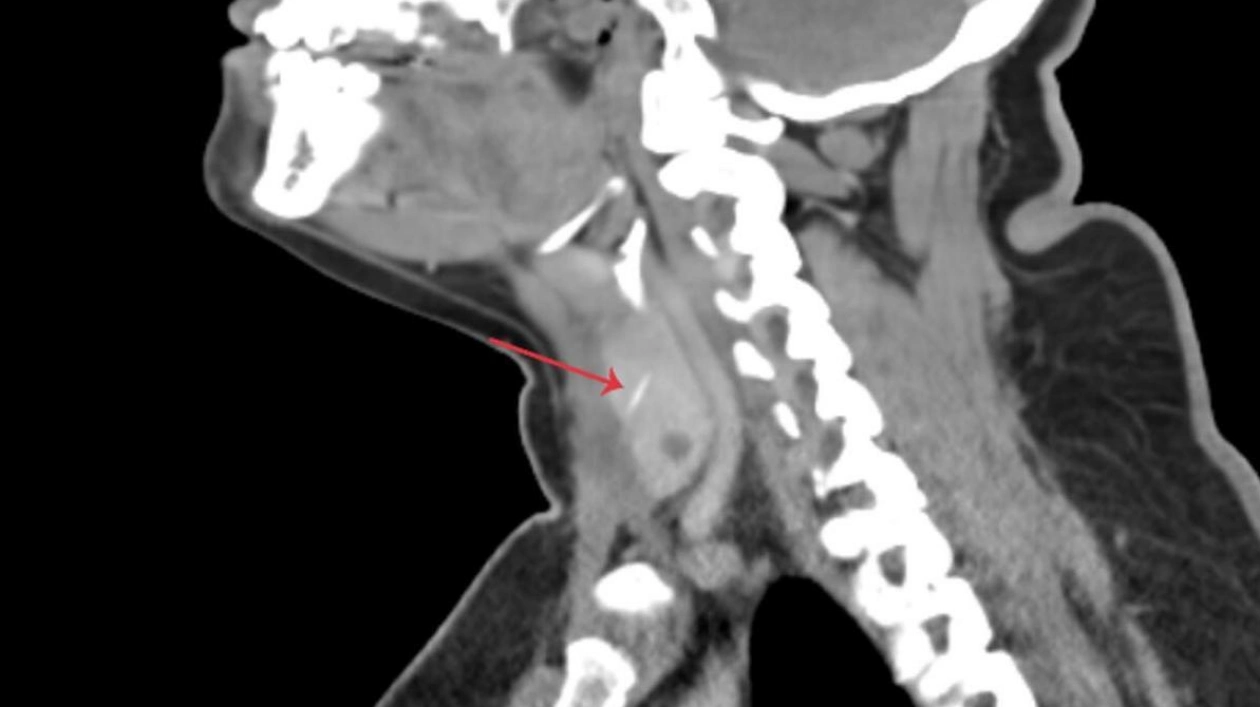 Fishbone Lodged in Thyroid Gland: A Rare Medical Case in Dubai