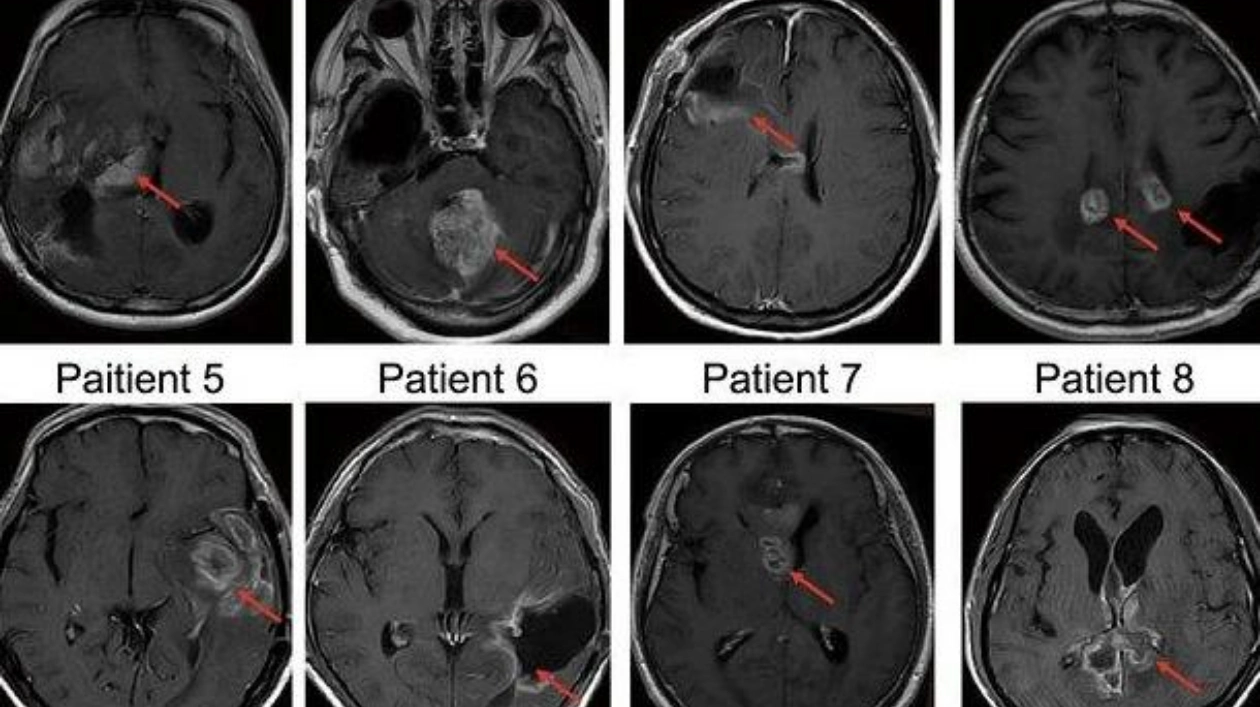 Новый противораковый вирус: прорыв в лечении глиобластомы