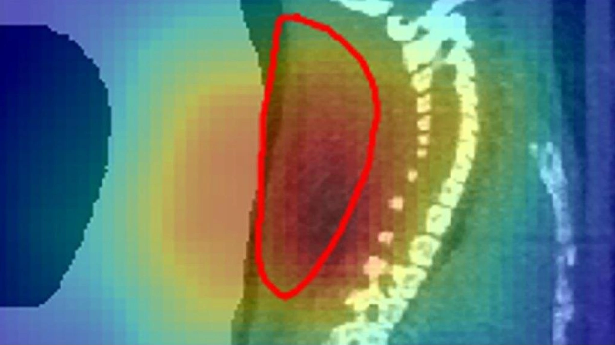 Radioactive Particle Beams Successfully Target Tumors in Mice