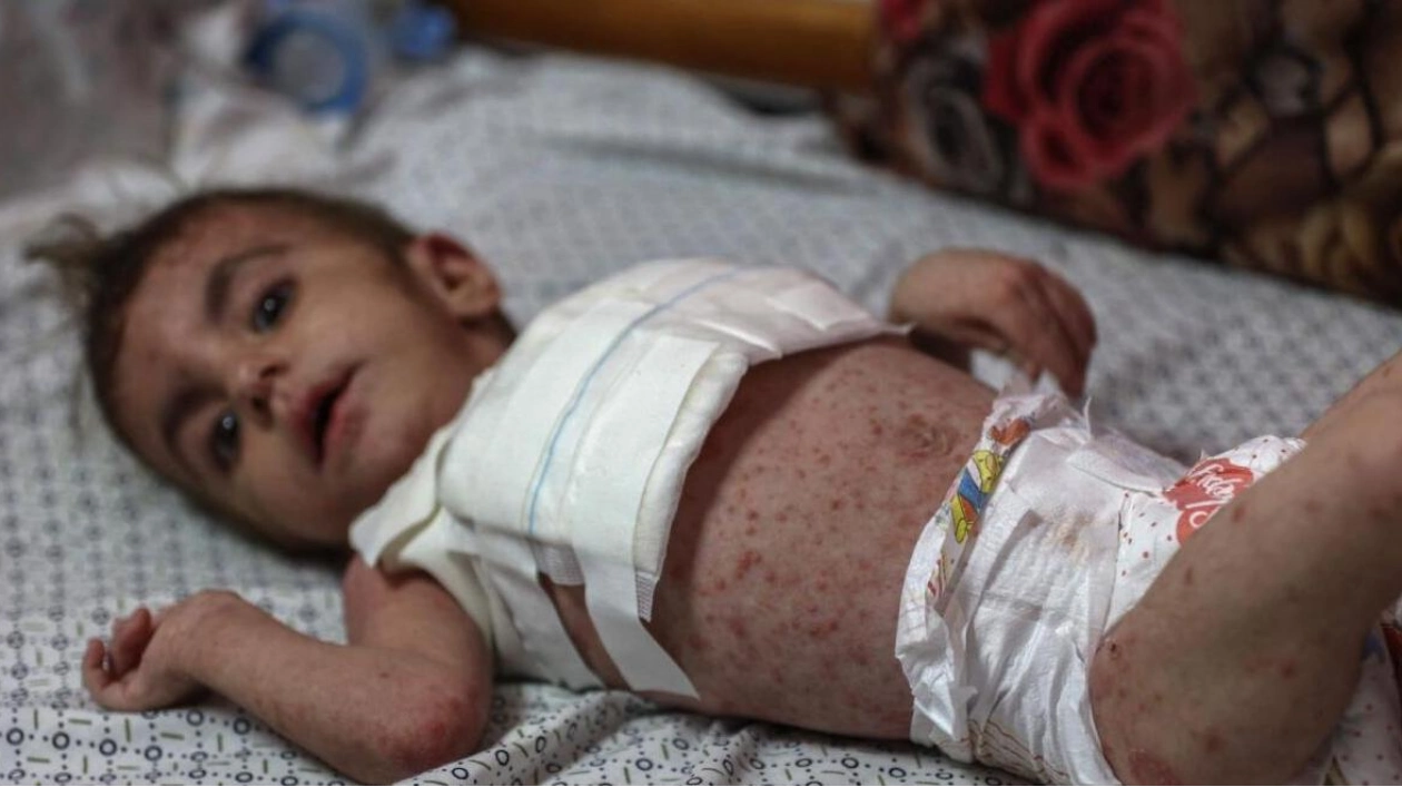 Gaza's Children Struggle with Skin Infections Amid War