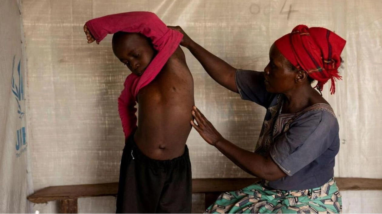 CDC Issues Second Alert on Deadly Mpox Virus in DRC