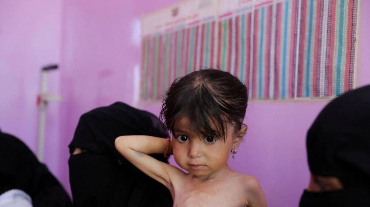 Acute Malnutrition Spikes in Government-Controlled Yemen