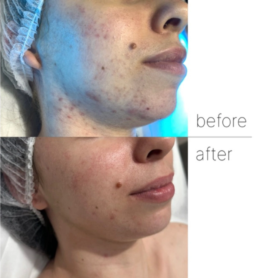 acne removal procedure. before and after