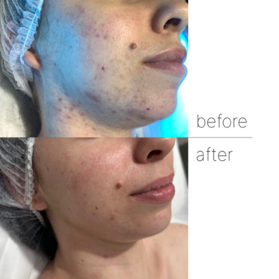 acne treatment. before and after